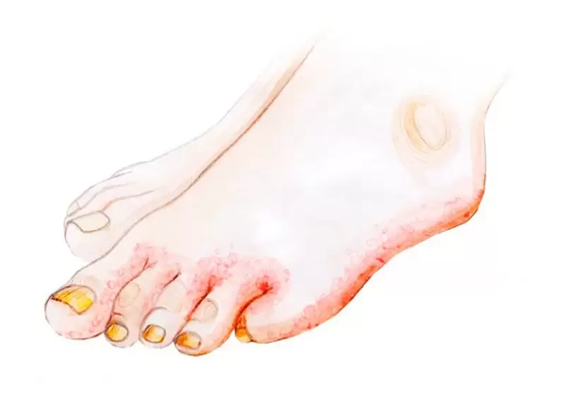 Mushroom on the toes and application of Zenidol cream