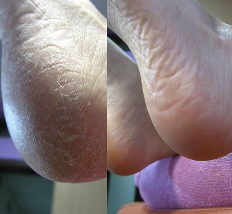 Photo of the corner of the foot before and after using Zenidol cream