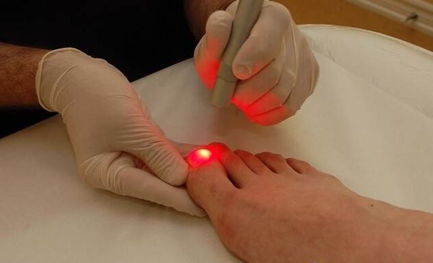 laser treatment against nail fungus