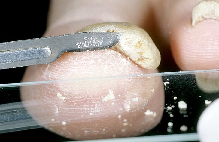 nail scraping to diagnose the fungus