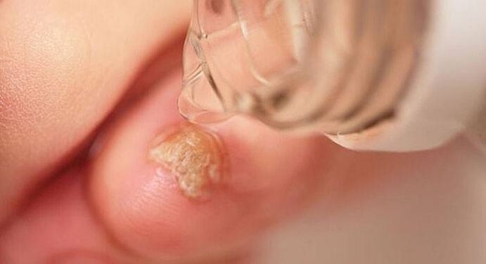 drops from the fungus on the toenails