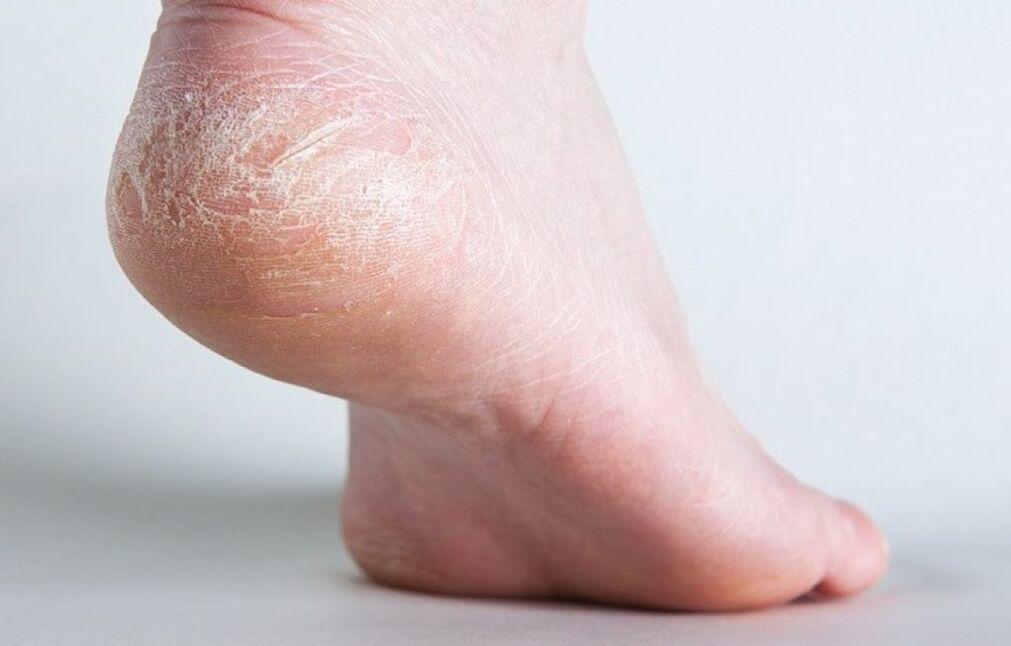 skin fungus on the foot how to treat