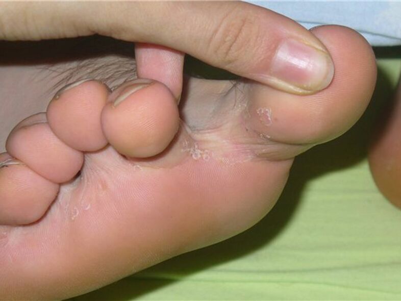 toe fungal symptoms