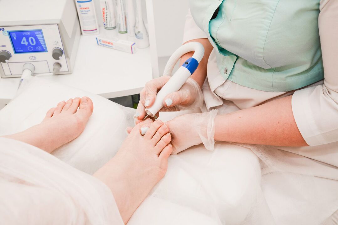 treatment of nail fungus by a doctor