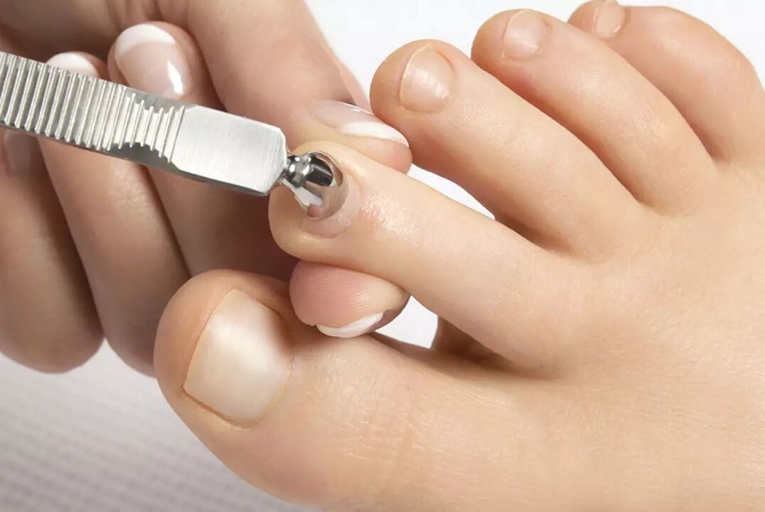 what to use against nail fungus