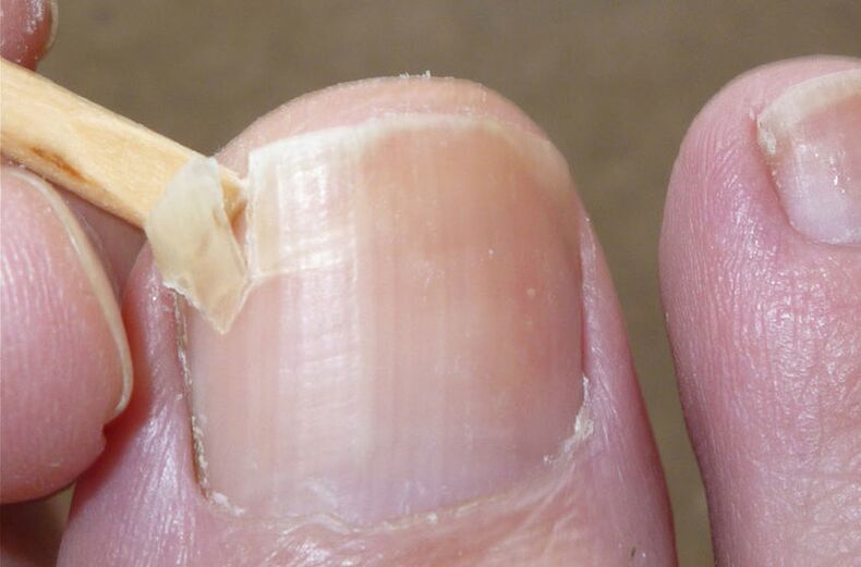 A damaged nail is a risk factor for fungal infection