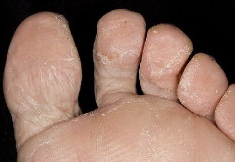 The initial section of the fungus between the fingers