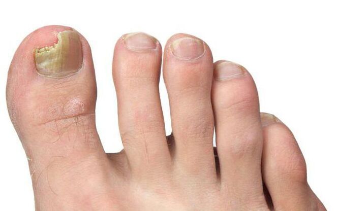 Mushroom on the toes