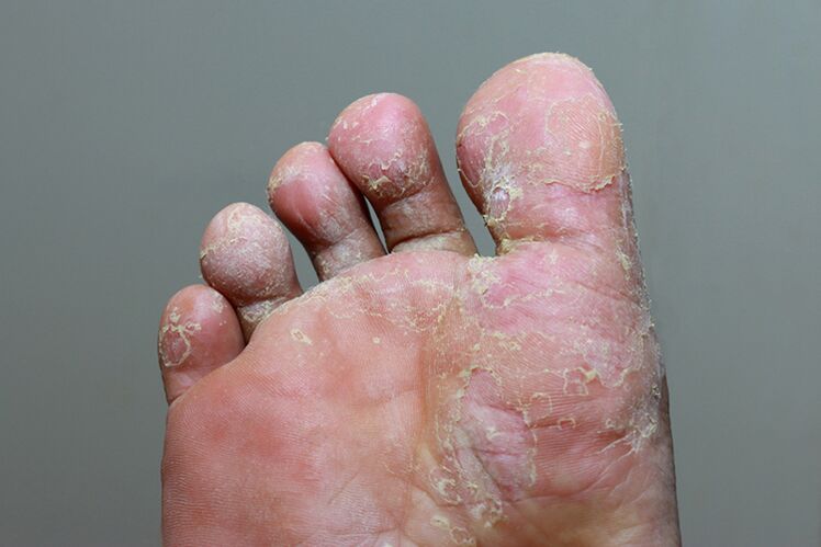 A severe stage of mycosis of finger skin