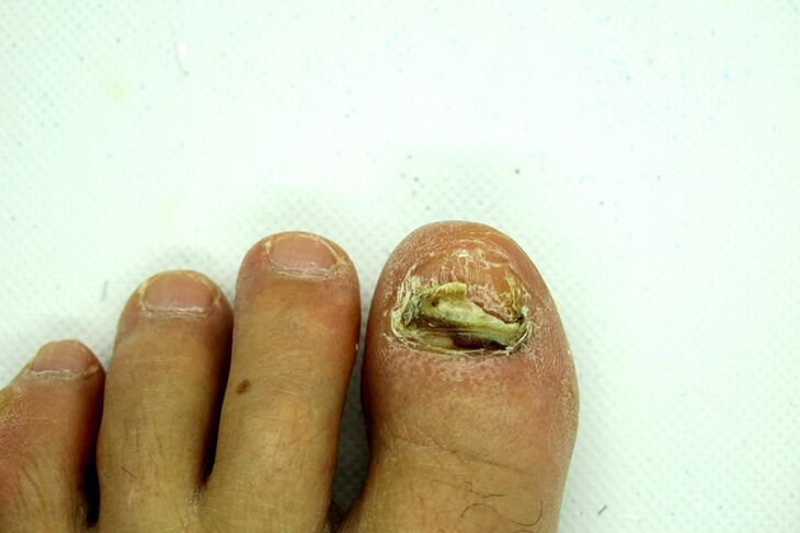 Finger nail fungus - heavy stage