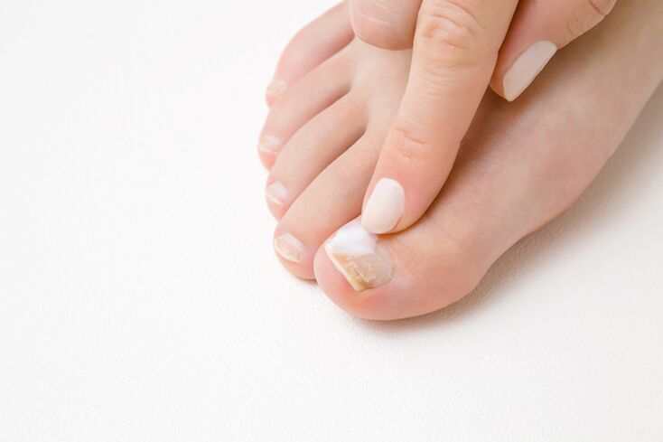 Finger treatment with fungal ointment