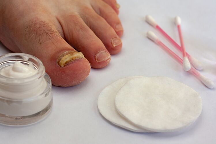 Fingers Mushroom Treatment with Fungal Cream