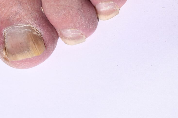 The initial stage of mycosis of the legs of the legs