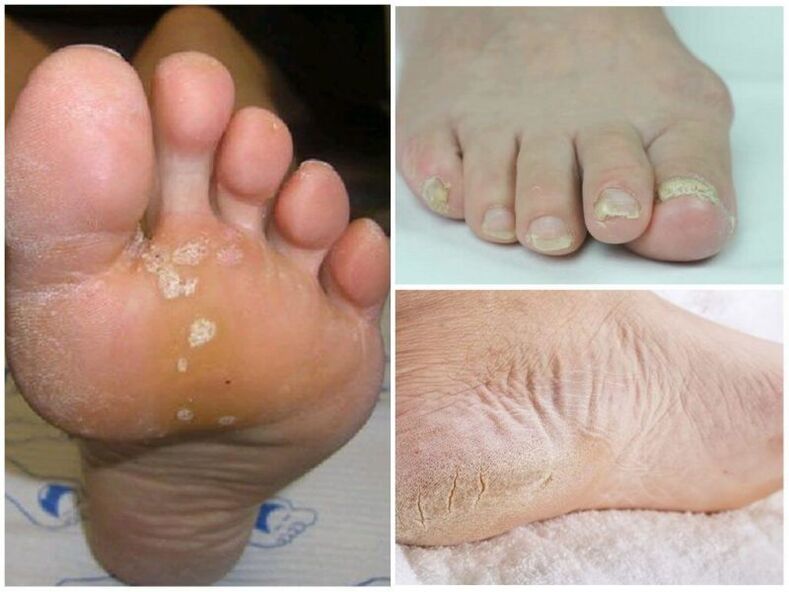The symptoms of mycoses