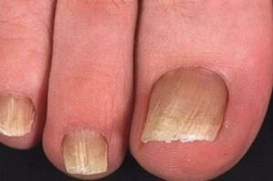 fungal nail infection