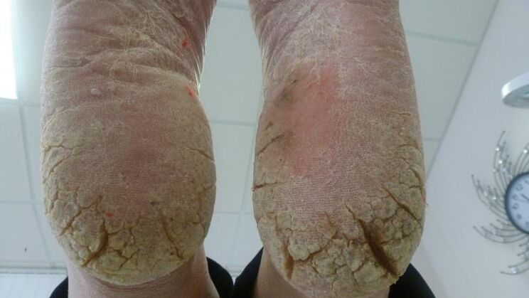 manifestation of fungus on the leg