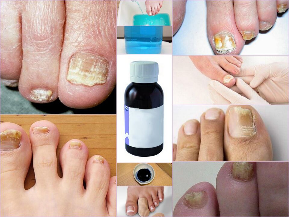 anti-fungal medications