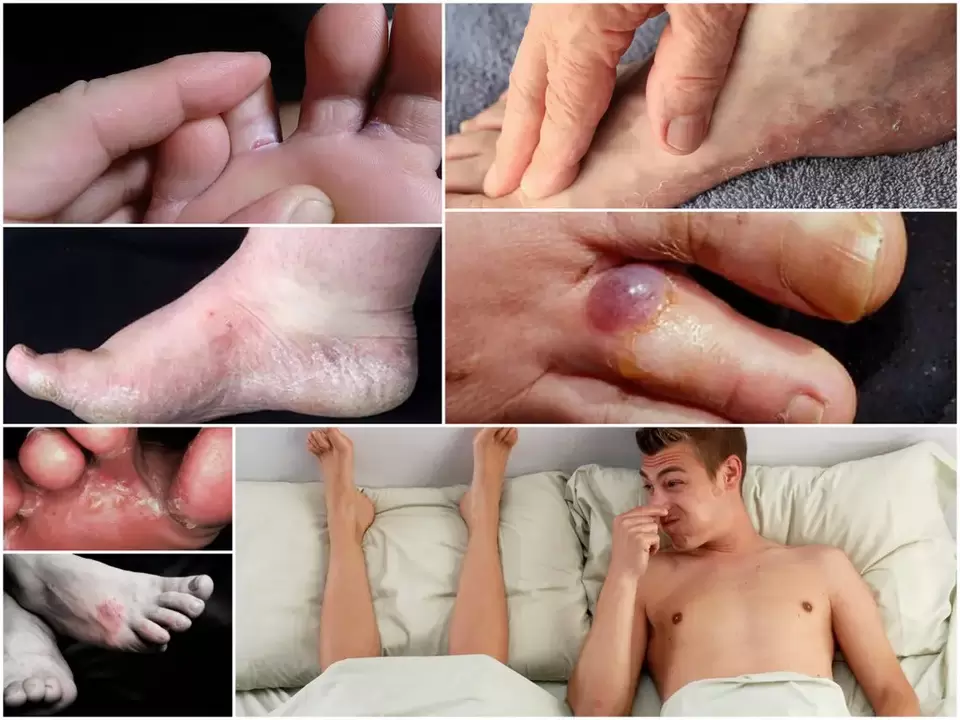 The main signs of athlete's foot