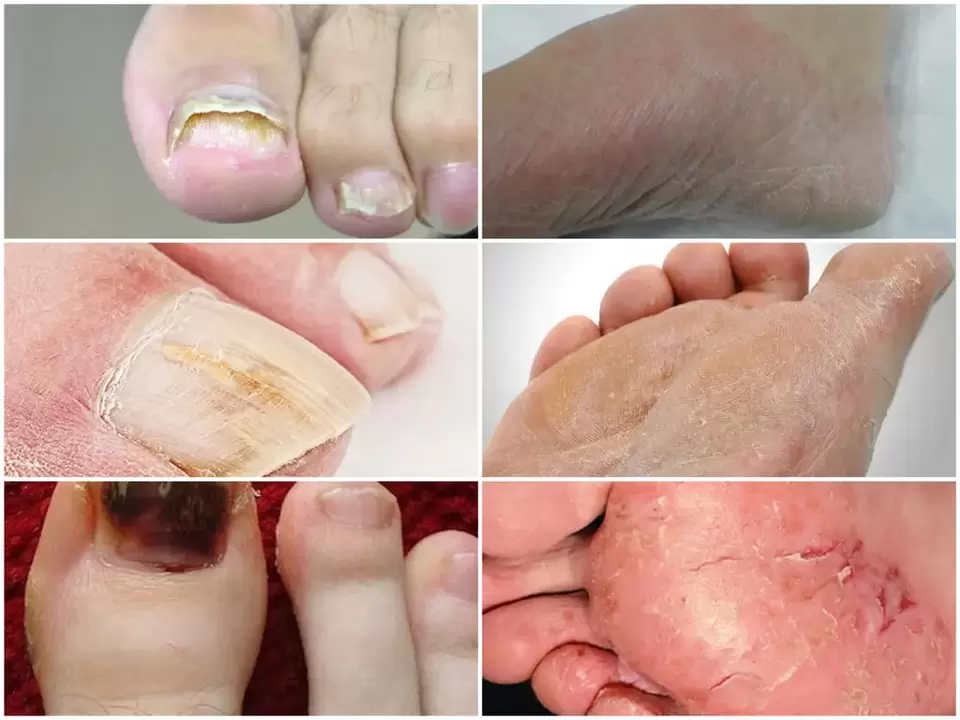 The manifestation of the fungus on the legs from various pathogens