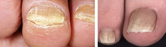 damage to the nail with a fungal infection