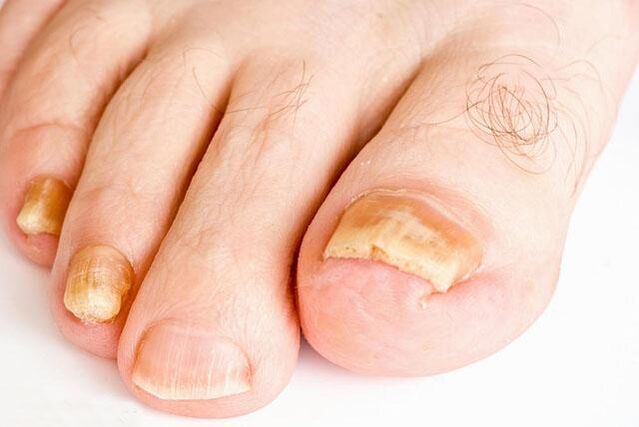 what does a nail fungus look like