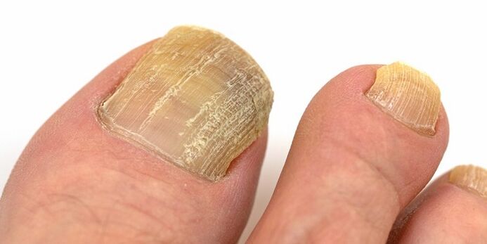 damage to nails with advanced fungal infections