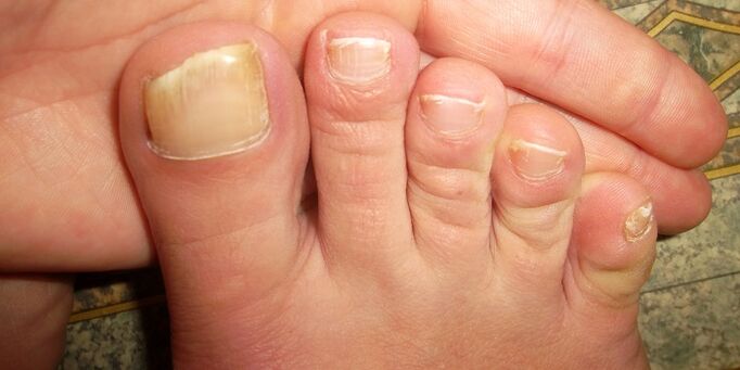 damage to nails with fungus