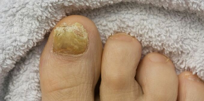 yellow nails with fungal infection