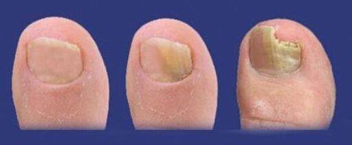 stages of fungal development on nails
