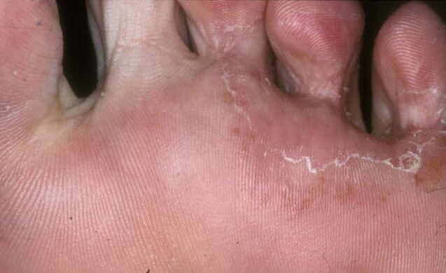 feet affected by the fungus trichophyton rubrum