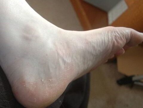 peeling of the foot is a sign of a fungal infection