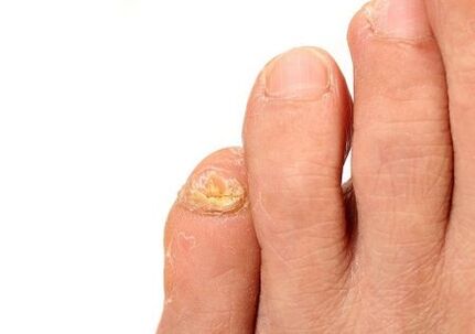 fungus affected by dermatophytes nails