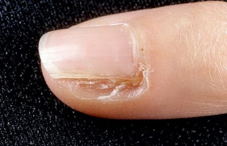 removing part of the nail with a fungus