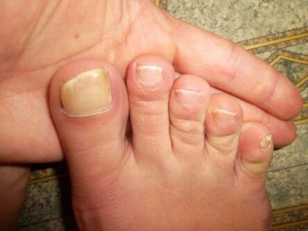 toenails affected by the fungus